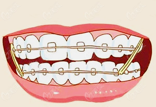 牙齿矫正优惠