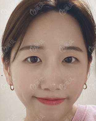 韩国双眼皮改单眼皮的手术实例照片