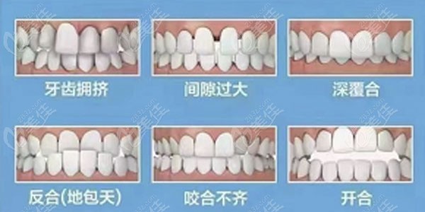 ETA儿童牙齿早期矫治