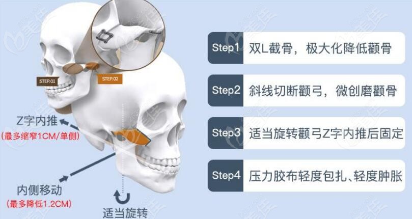 北京联合丽格医院磨骨技术图