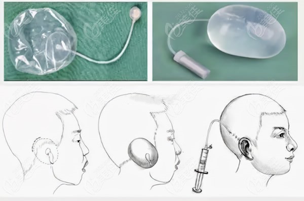 全包法耳再造一期手术过程