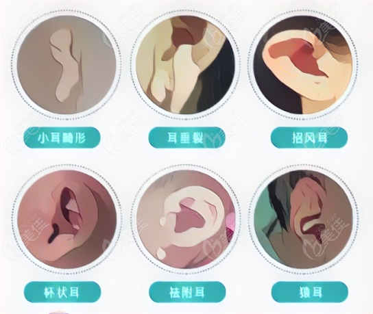 哪个年龄段的孩子更适合做小耳再造手术
