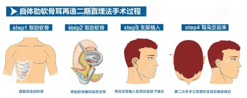 北京耳再造好的医院做肋骨耳再造手术优势