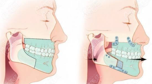 正畸和正颌手术的区别