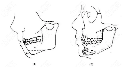 颏成型和正颌能一起做