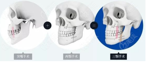 正颌和颏成型一起做花了15万左右