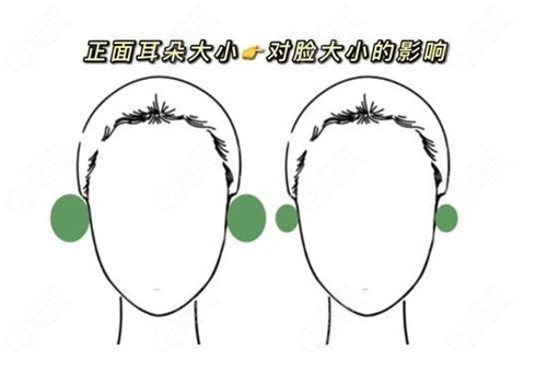 贴发耳是侧睡压着造成的吗 要是用手掰可以矫正吗 贴发耳矫正 美佳网整形问答