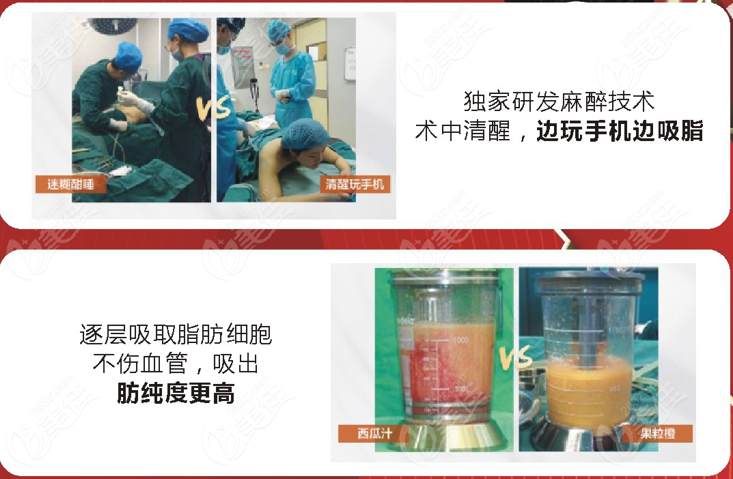 苏州美贝尔美容医院的快乐吸脂技术