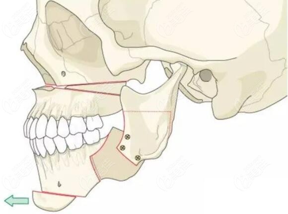 正颌手术搭配颏成型术