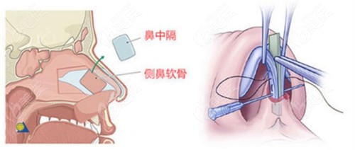 哈尔滨艺星整形隆鼻技术