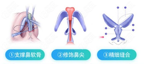 尹又阶院长做鼻子技术