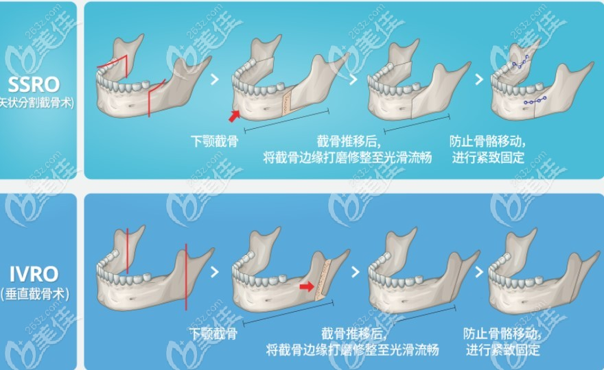 下颌骨突出矫正手术怎么做