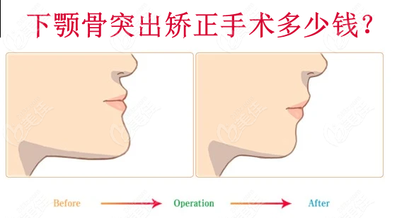 下颚骨突出矫正手术需要多少钱