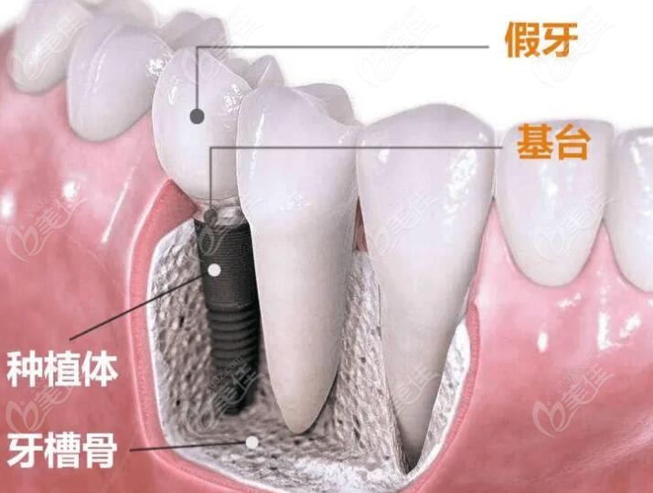 种植牙是什么样呢