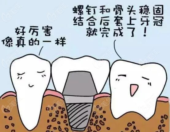 整个种植牙的治疗过程