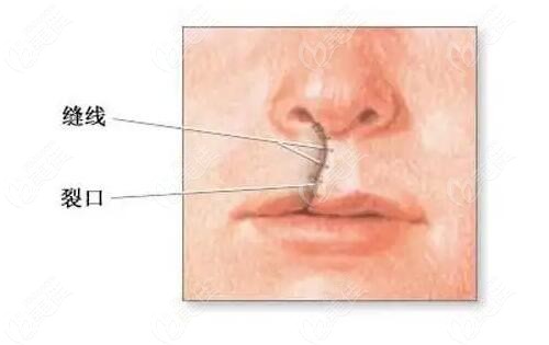 唇裂修复手术的缝合位置
