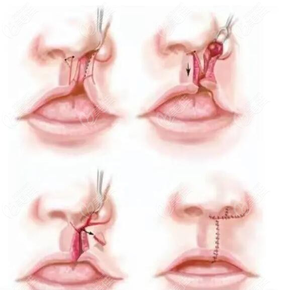 唇裂修复手术过程