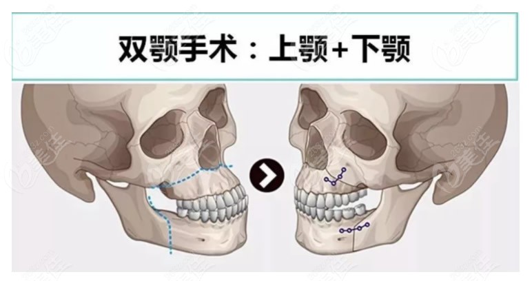 正颌手术过程图解