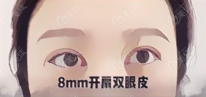 8mm开扇双眼皮2年后的图片