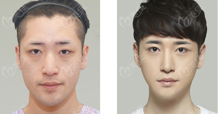 韩国BORNDI整形医院朴正日正颌手术前后脸型对比图