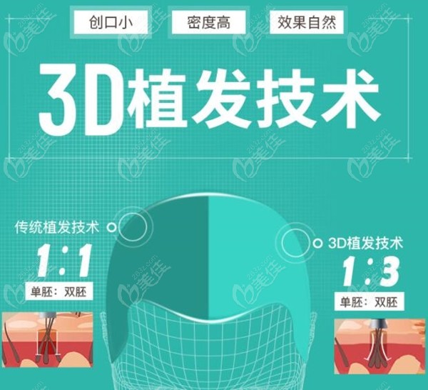 杭州新生tddp和3D植发价格是多少钱一个毛囊?这两个技术有什区别
