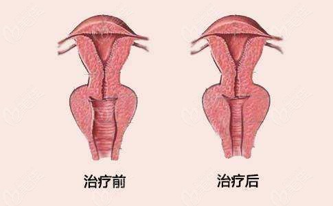 歐洲之星蕊麗縮陰術(shù)前術(shù)后對(duì)比圖