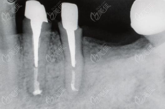殘根做樁核修復(fù)后的全景片