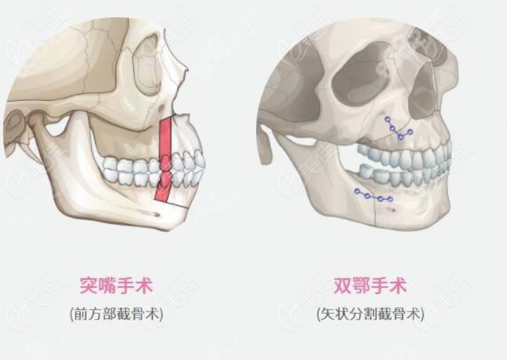 凸嘴手术和正颌手术的区别图片