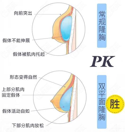 广州内窥镜假体隆胸优势