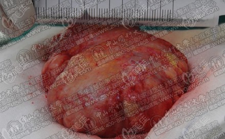 胸部清奥5万不贵