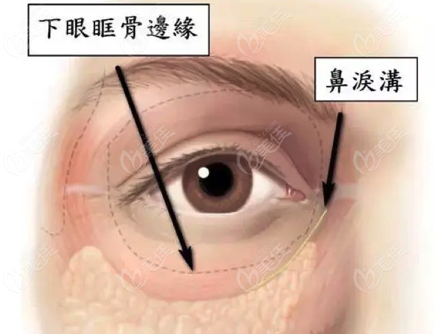 為何有人做了眶隔釋放之後淚溝更加深了呢?