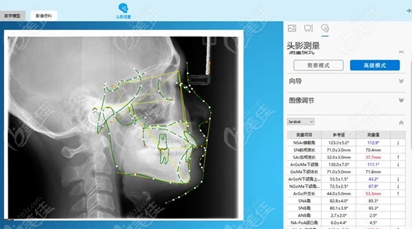 国产Hibeauty隐秀矫正分析系统