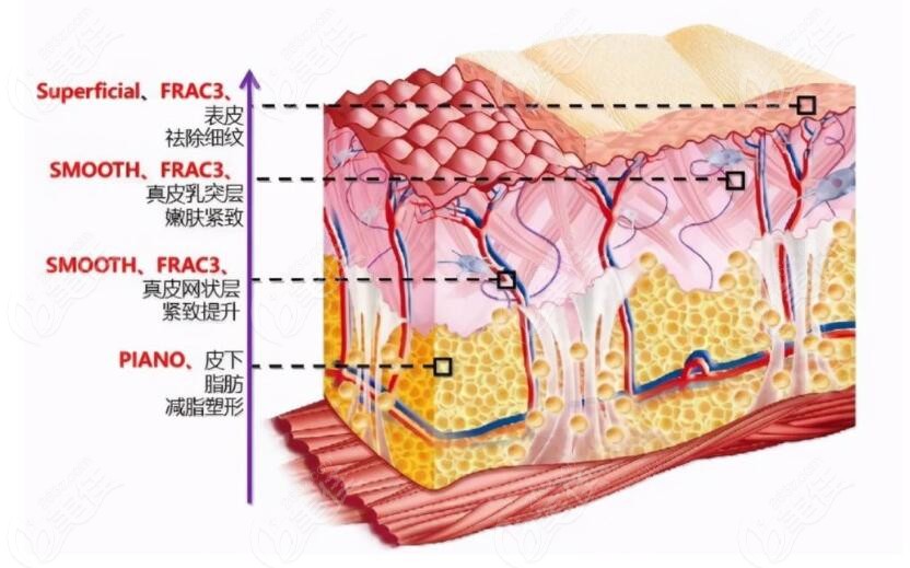 欧洲之星Fotona 4d治疗模式