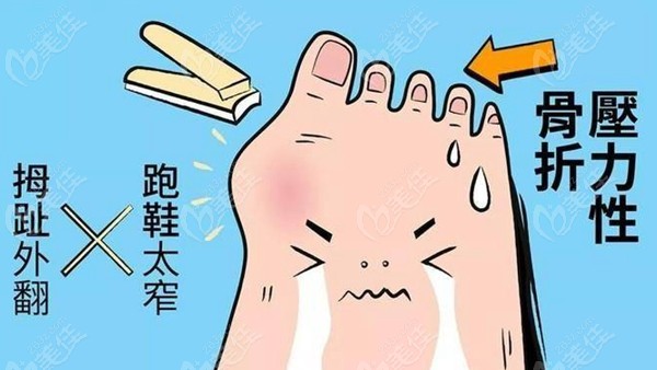 大脚骨外翻很疼