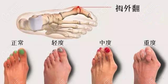 上海丽质的卢九宁院长大脚骨矫正类型