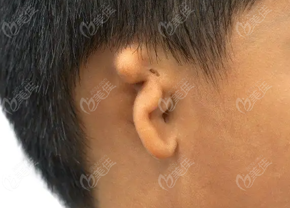 新生儿小耳畸形是什么原因造成的