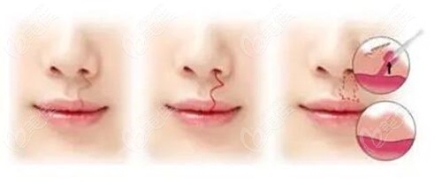 激光治疗唇裂疤痕原理