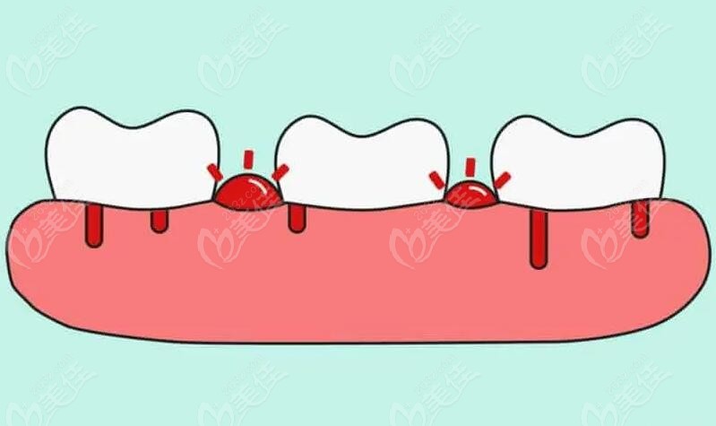 壞死性潰瘍性牙齦炎