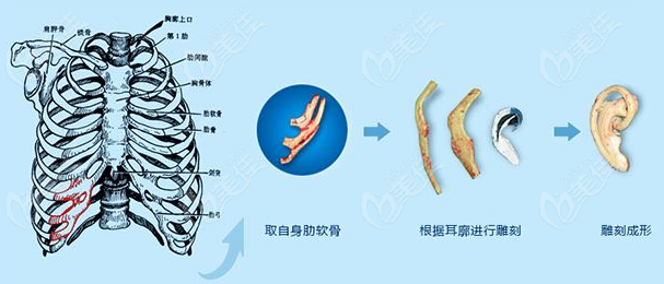 耳再造手术取哪几根肋骨