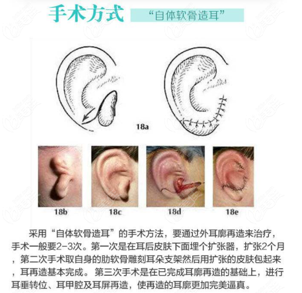 肋软骨耳再造手术方式