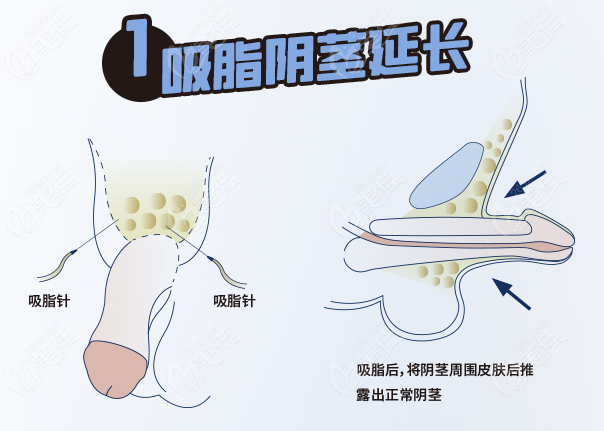 男性延长手术有风险吗图片