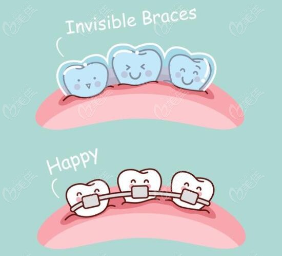 两种牙齿矫正方式