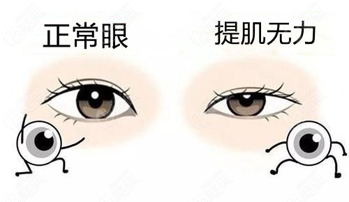 北京郑永生医生修复双眼皮实例:双眼皮做了2年眼睛闭不上成功修复好