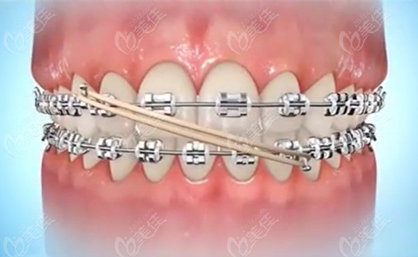 杭州雅莱齿科正畸医生沈岩岩主要开展各类牙齿正畸治疗