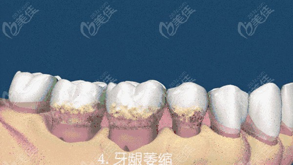 牙槽骨吸收了還能長回來嗎如果牙槽骨吸收了一半還有救沒