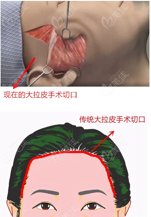 传统大拉皮手术和现在大拉皮手术切口不同