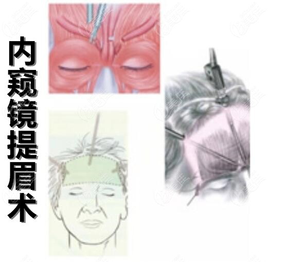 内窥镜提眉术是什么
