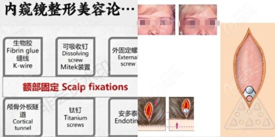 内窥镜提眉术的固定方式
