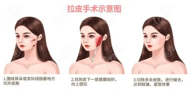 拉皮手术过程示意图