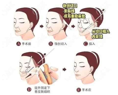 拉皮手术操作过程